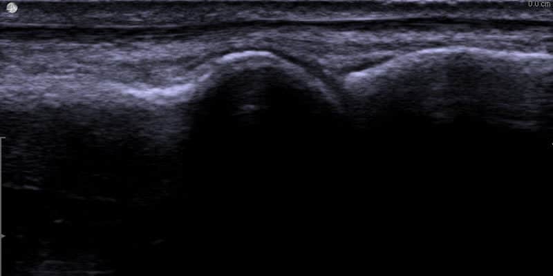 Ultraljudsbild av frisk mtp1-led (stortå led)