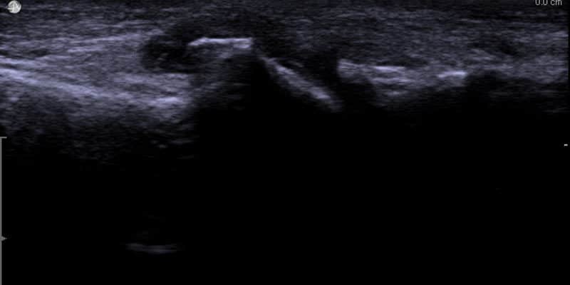 Ultraljud av skadad MTP 1-led (stortå led). Benpålagringar och vätska (svart i bild) syns utanför leden.