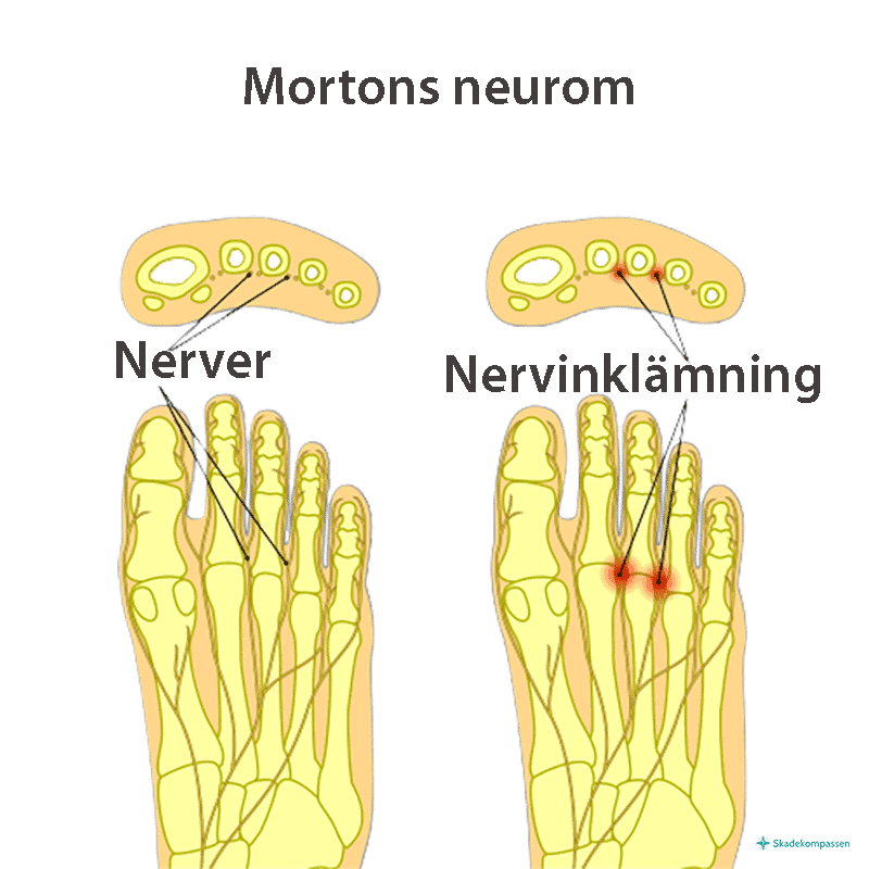 Mortons neurom - inklämning av nerv med smärta och nervpåverka i framfoten och ut i tårna