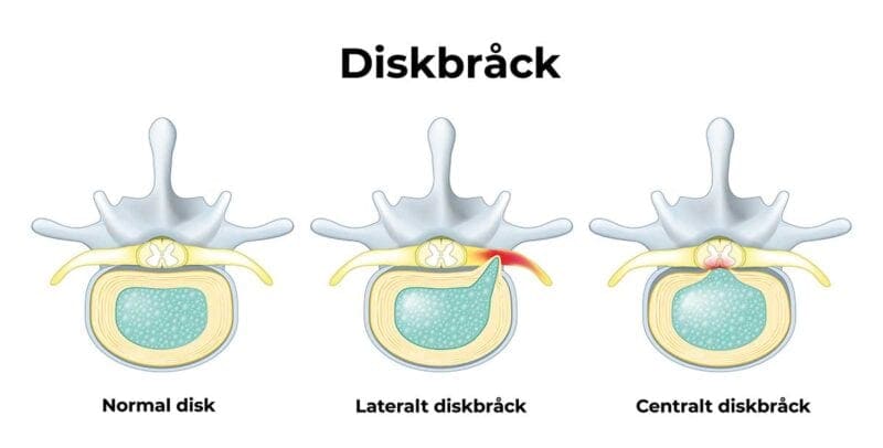 diskbrack-i-nacken-2